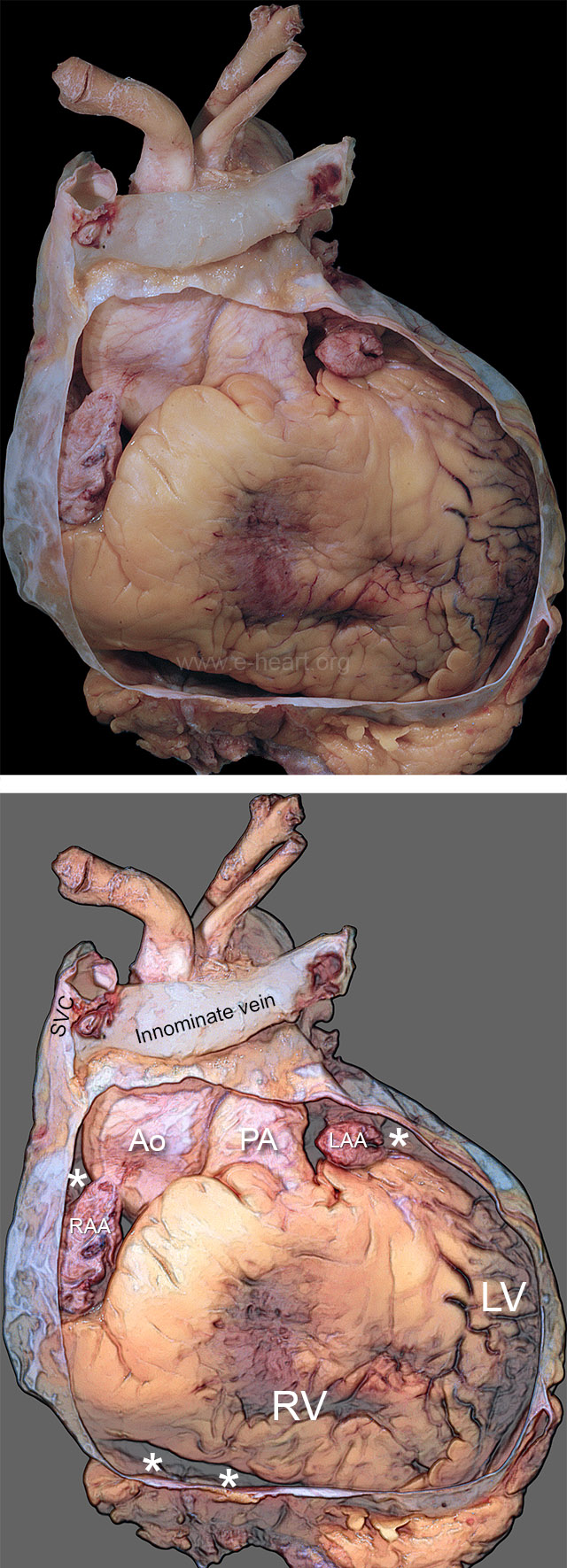 Fibrous pericardium gross 